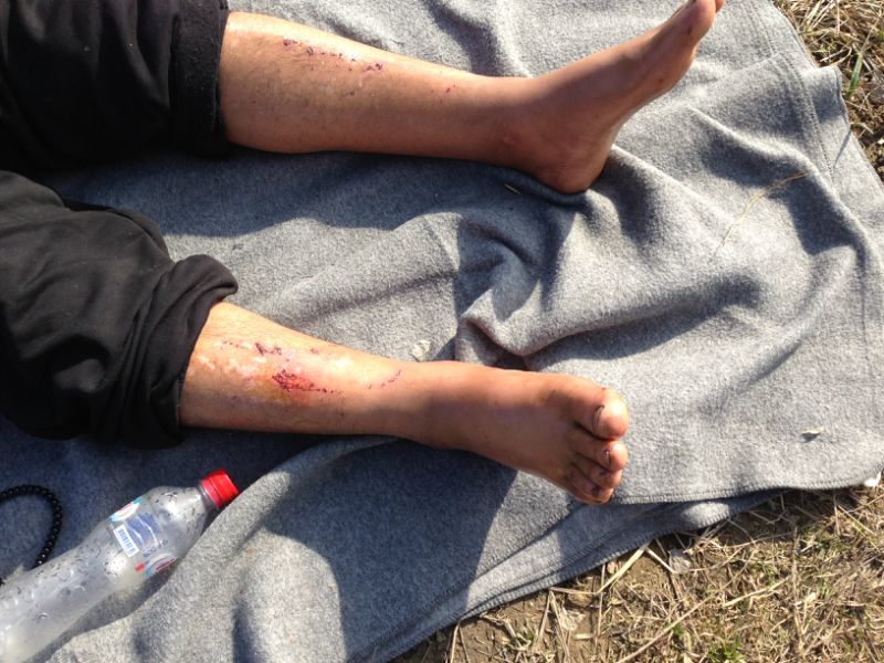 A lába köré tekerték a szögesdrótot - gyűlnek a bizonyítékok a menekültek elleni rendőri brutalitásról